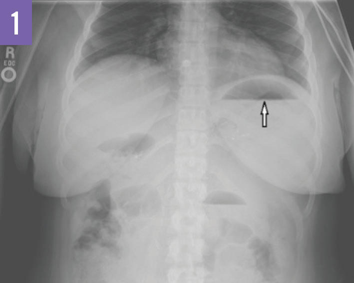 Internal Hernia and Gastric Remnant Perforation After Gastric Bypass